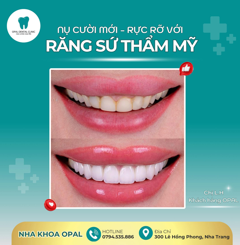 Khách hàng bọc răng sứ tại nha khoa Opal