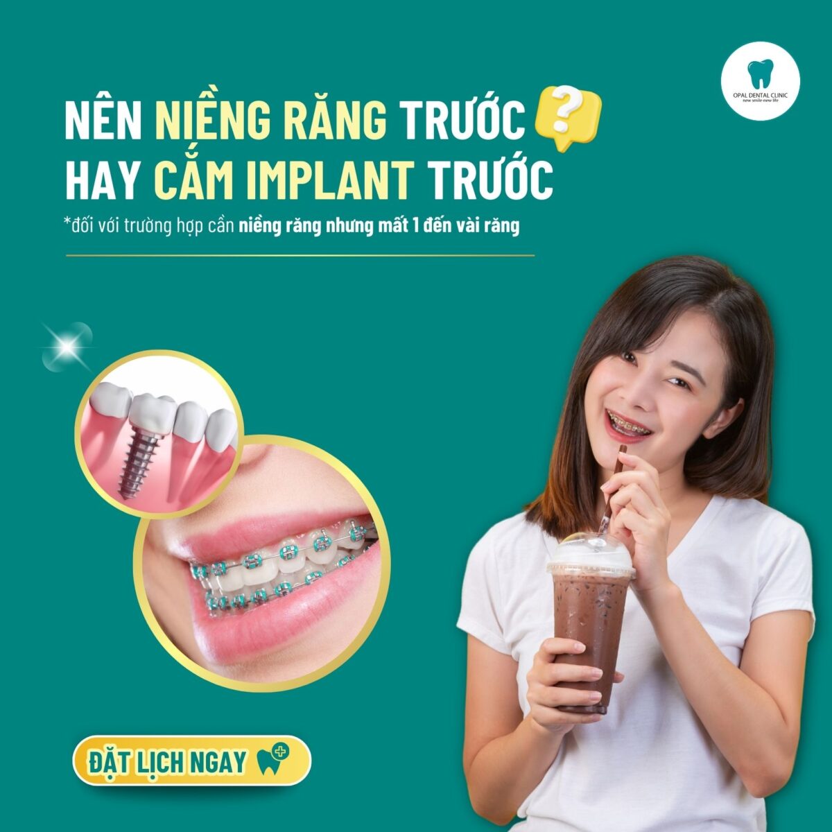 trong-implant-co-nieng-rang-duoc-khong