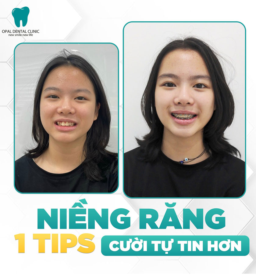 Khách hàng niềng răng tại nha khoa Opal