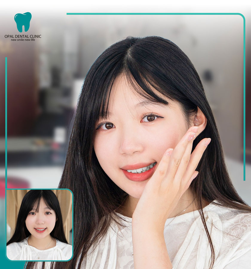 Khách hàng niềng răng tại Nha khoa Opal